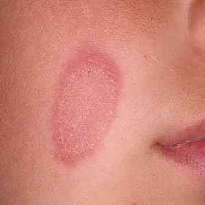 Проявления аллергии в виде красных пятен на коже лица и тела — Все ...