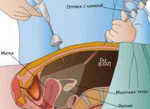 Лапароскопия кисты яичника: подготовка и проведение